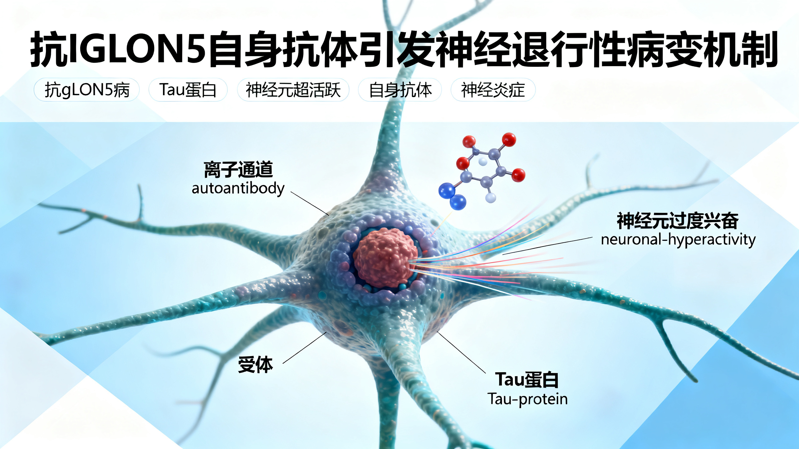 IgLON5自身抗体引发神经元过度活跃，进而导致Tau蛋白异常